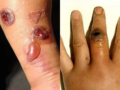 由于炭疽是炭疽杆菌引起的人畜共患急性传染病,人类接触病畜及其产品