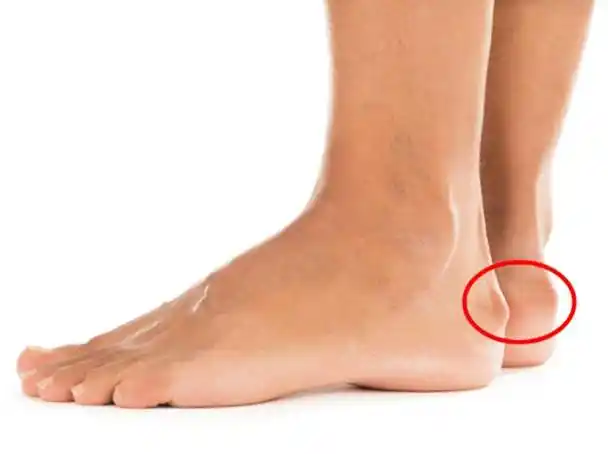 脚后跟疼痛肿胀,是跟腱炎还是滑囊炎,要做手术吗?