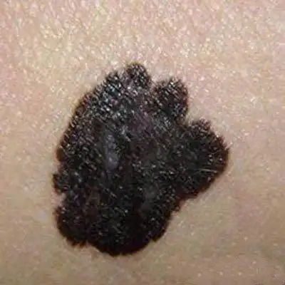 黑痣6大症状预示癌变 - 好大夫在线