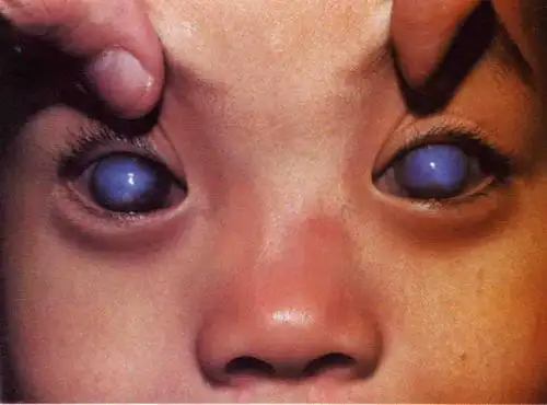 青光眼可预防吗?