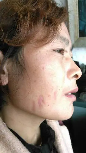 1脸上抓痕二十多天仍不退去算毁容吗