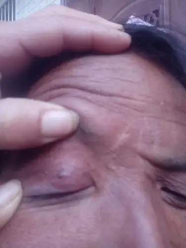 眼皮上长个像是瘊子的请问谁知道,如何治疗