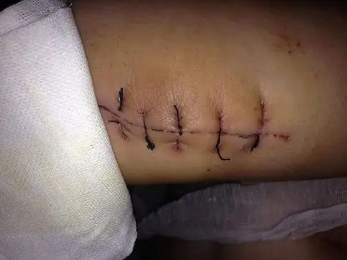 切口是这样的具体怎么做的手术我不清楚了