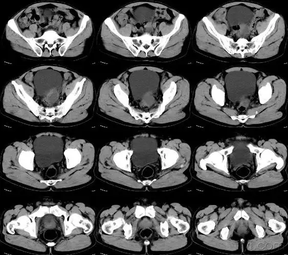 盆腔占位/ct/公布结果/100128