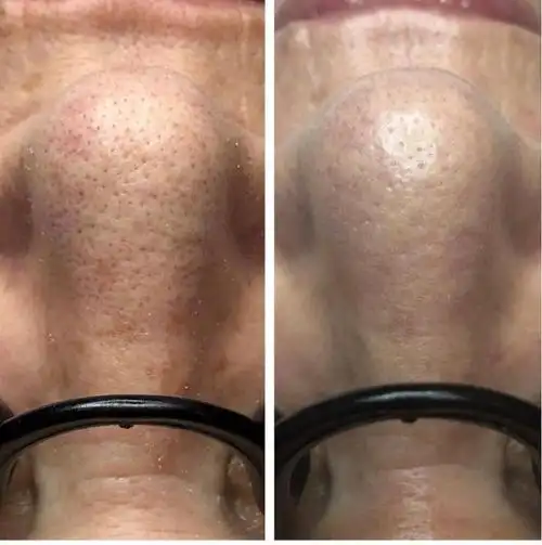 深圳医美团|花30分钟与黑头说再见!_皮肤