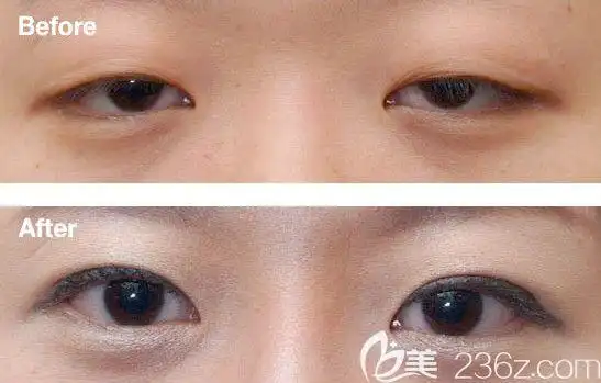 眼睛怎么都睁不开开个双眼皮就能解决吗