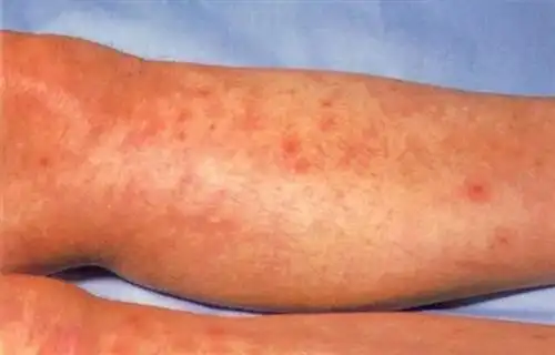 流行性出血热症状图片