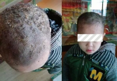 自幼头上就长有疮(见图),皮损密布于整个头部,自觉痒,痛,查体可见颈部