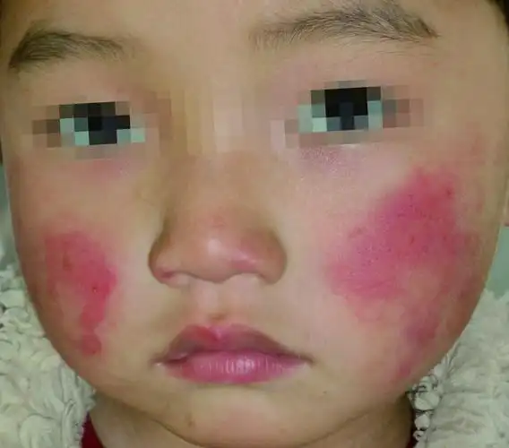 皮肤性病科图谱病毒性皮肤病传染性红斑