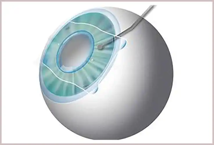 近视手术分享 | 重见光明的感觉,真好!