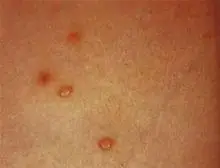 症状诊断/鉴别_症状检查_治疗/预防_硬下疳是由什么原因引起的-求医网