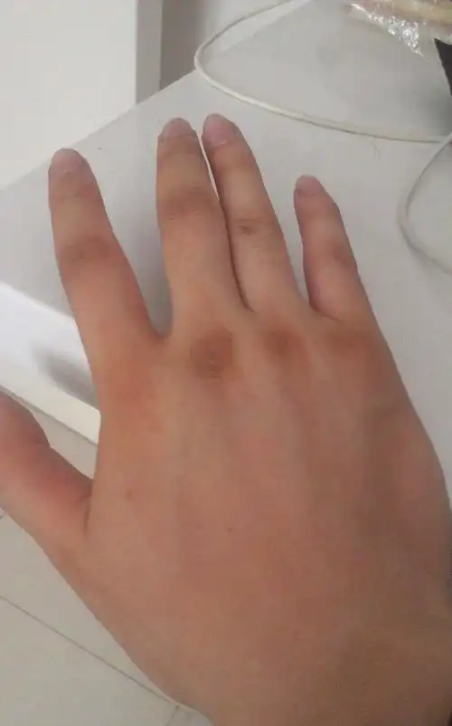 手指关节黑是怎么回事