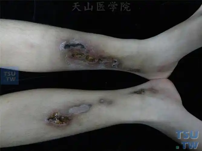 坏疽性脓皮病pyodermagangrenosum症状表现