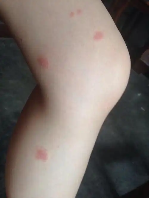 手上腿上不知道被什么东西咬了,疑似蚊子咬的,隔天之后出现红斑,上面