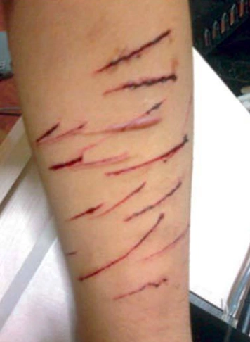 胳膊流血真实图片 (20)_有来医生