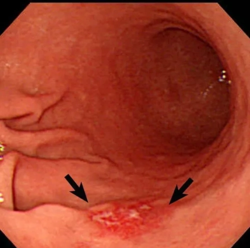 胃镜下早期胃癌表现