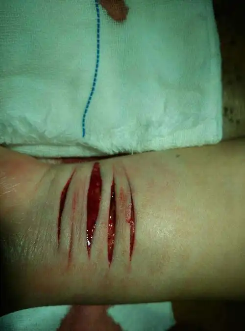 情人节当晚8点,蚌埠第八人民医院外科门诊部接诊了一位手腕严重受伤的