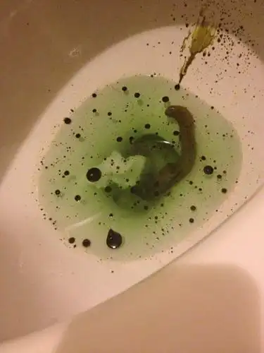 今天大便拉出很多墨绿色的油,是什么原因?