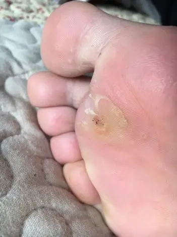 脚上长跖疣怎么办,真心烦恼啊,有没有试过什么方法治