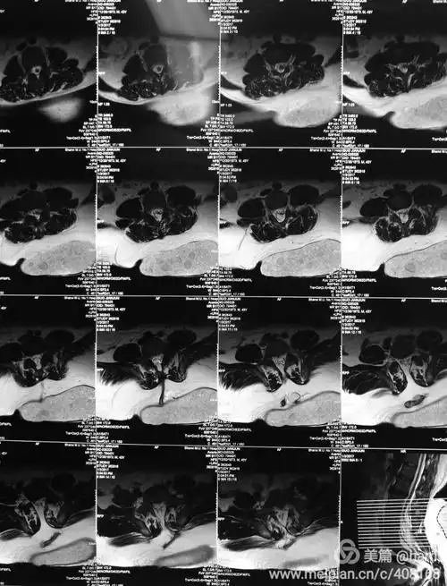 正确认识腰骶部肿块,别让"肿瘤君"嚣张
