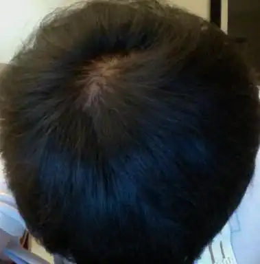 20岁男生,头顶头旋处头发稀少,其他地方头发还可以,不多不少,我不脱发