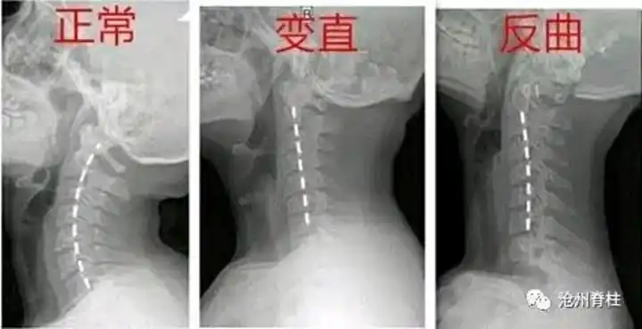 颈椎生理曲度变直还能恢复吗?_王延国医生文章_山东大学齐鲁医院(青岛