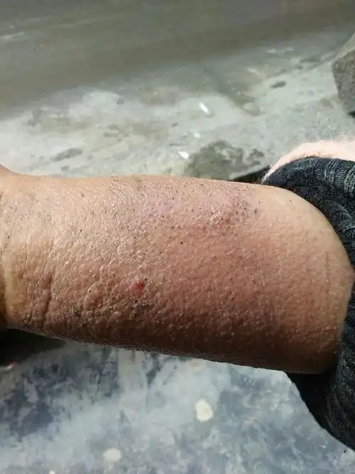 苔癣样湿疹冶疗5天对比