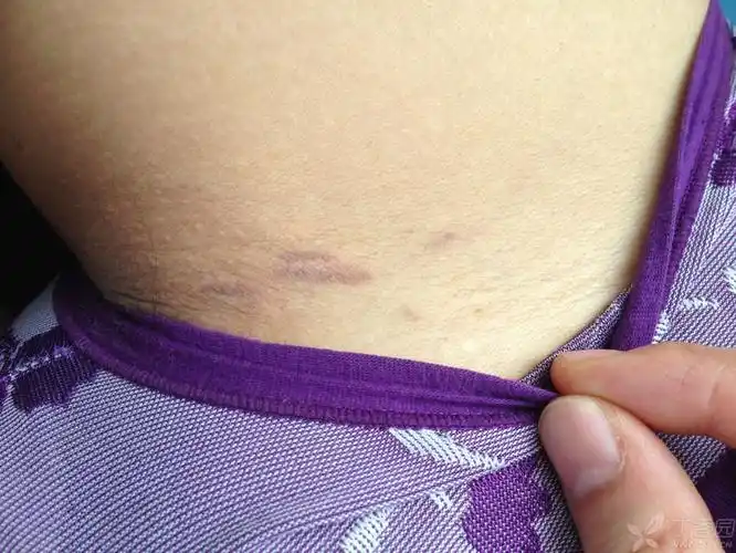 腹股沟,双侧皆有皮疹