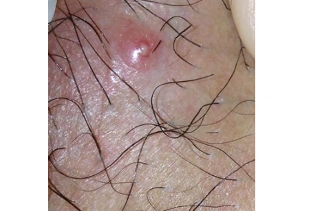 临高县梅毒专家_临高县治疗梅毒哪个专家好_临高县治