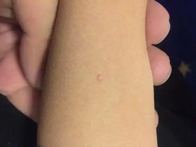 孩子胳膊上突然发现有个小疙瘩?