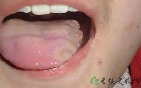 2,嗓子长疱疹也就是疱疹性咽炎.