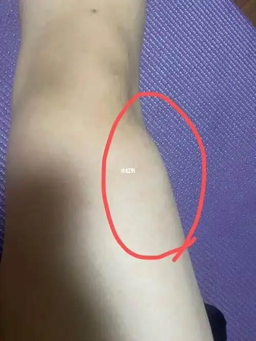 大腿外前侧一块肌肉凸出来怎么办呀