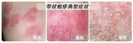 带状疱疹蛇缠腰会传染吗