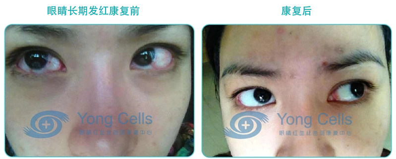 此图为康复前和康复20天后照片,仅供参考,更多疑问可以联系我们的在线