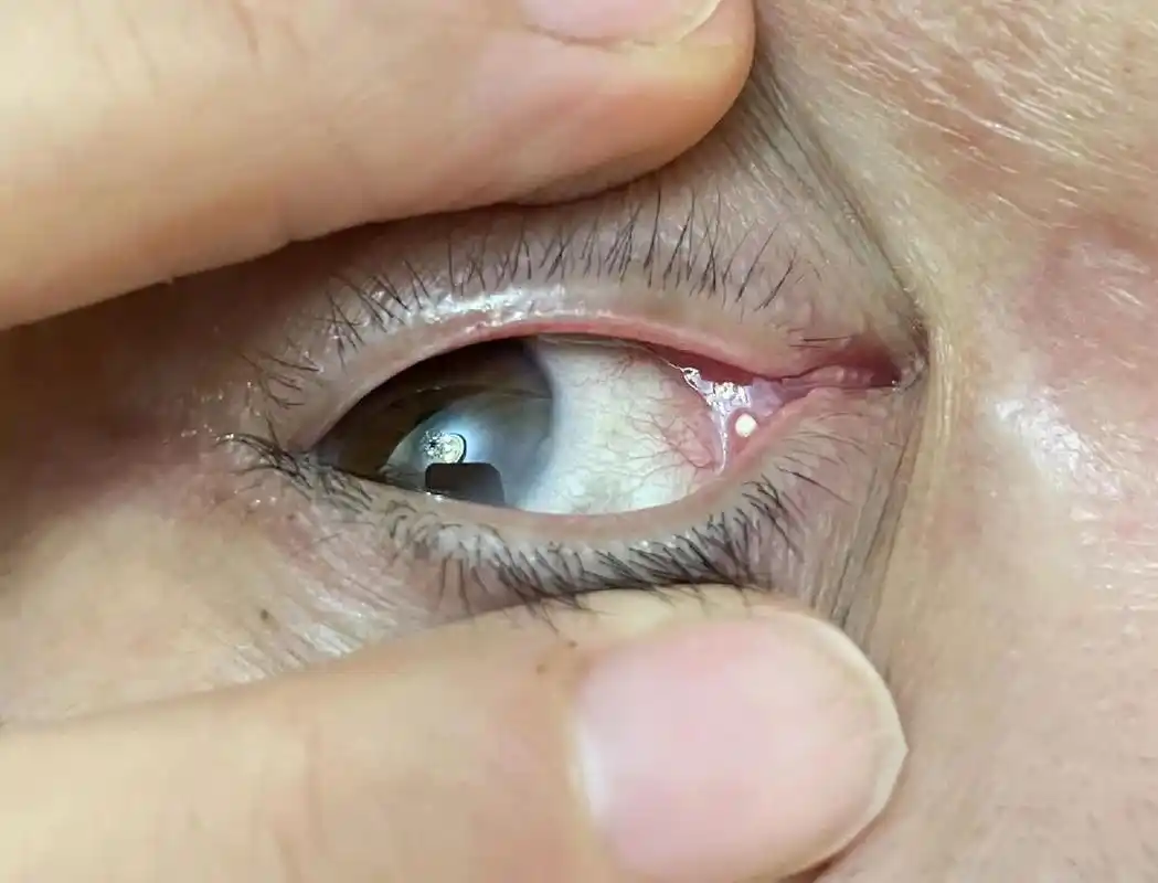 99眼睛长结石是指眼睛的结膜长结石,就是在上下眼皮内侧面,即睑