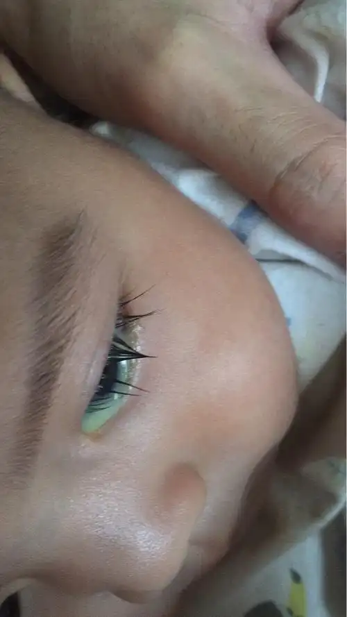 这是泪腺堵塞还是上火,有专业宝妈求解下,谢谢