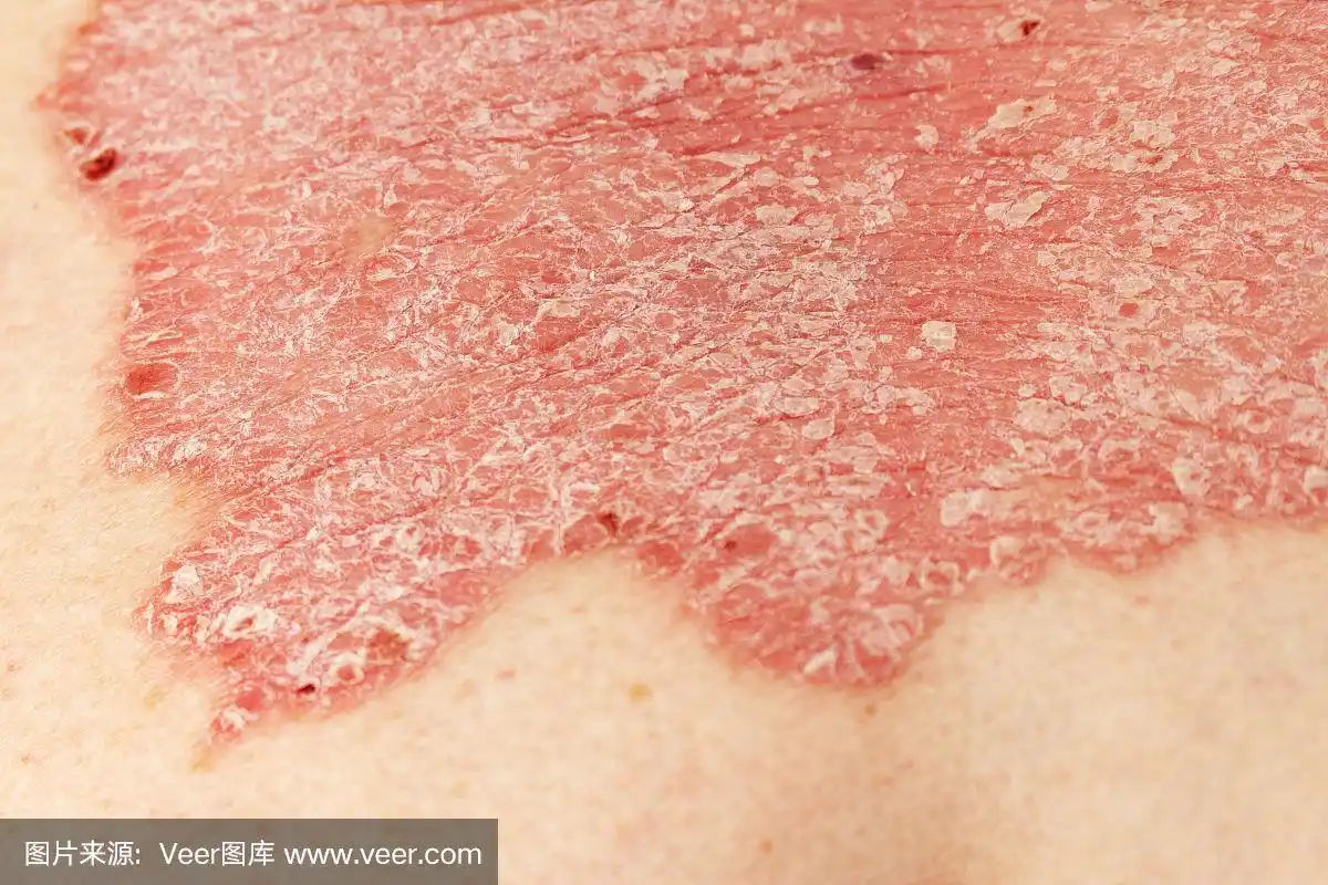 寻常型银屑病病灶狭窄,皮肤呈典型的红色,发痒和鳞屑状