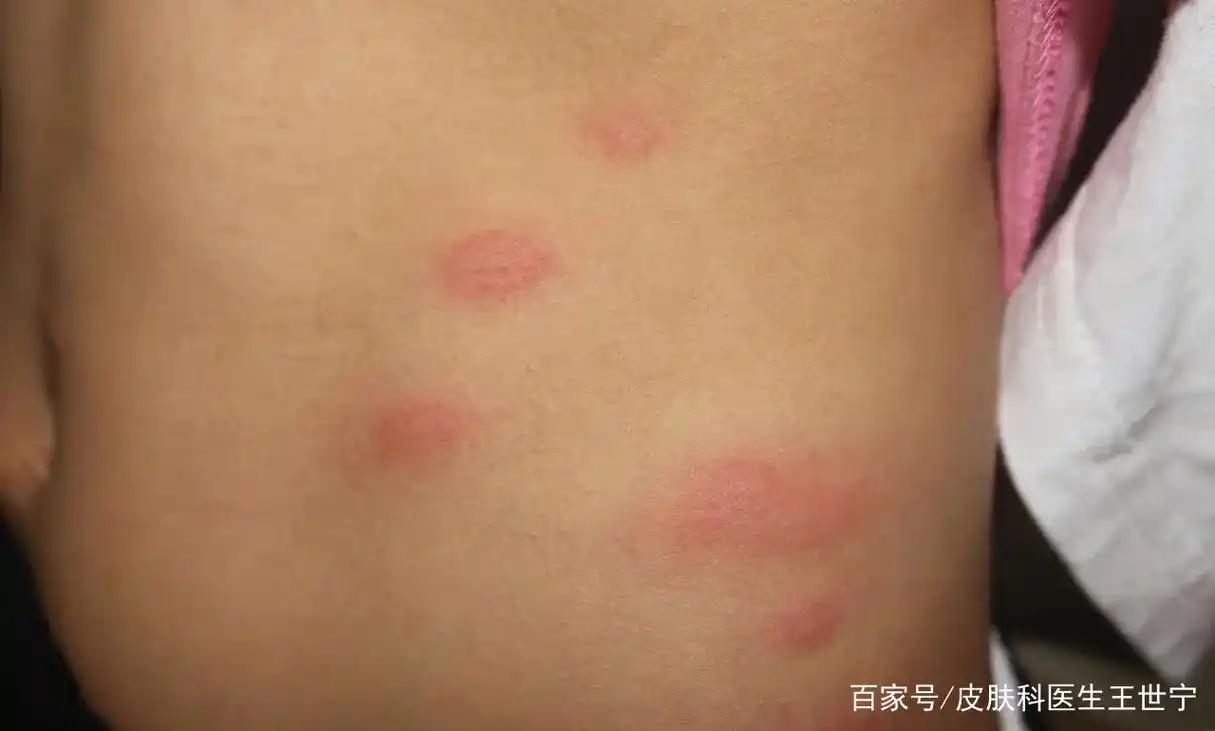 丘疹性荨麻疹!
