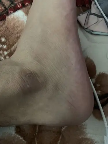 脚踝的皮变硬这是什么情况?