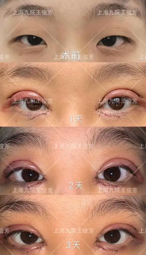 眼综合全切倒睫开眼角案例分享