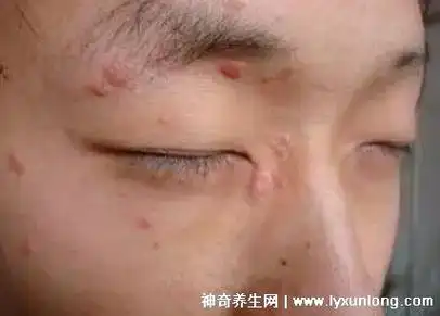 男性各种疣体的图片合集