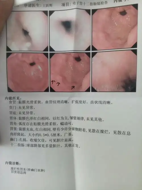 男,四十三岁,多年糜烂性胃炎,检查的胃镜如下,这是什么原因,应该怎么