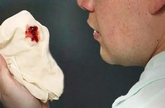 患上肺癌,除了咳嗽还有别的症状么?医生:注意这6个!