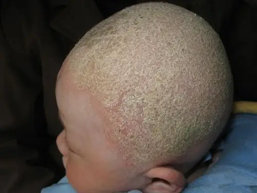 女生的头癣初期图片_有来医生