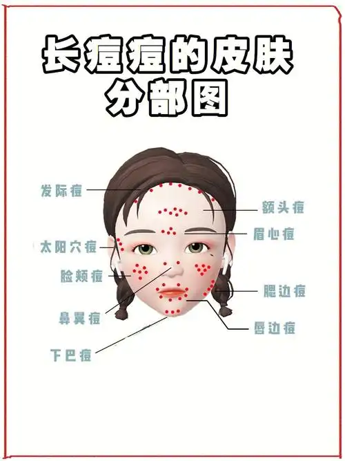 长痘痘的皮肤分部图757575教你学习会看痘痘