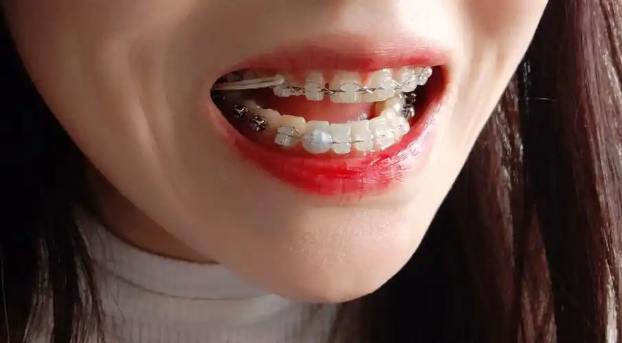 大龄正畸 修复,陶瓷自锁托槽,牙缝和过小牙蜕变历程.