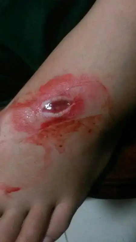 脚给菜刀掉下时弄到已经两天了该怎么办?吃的东西该注意些什么?