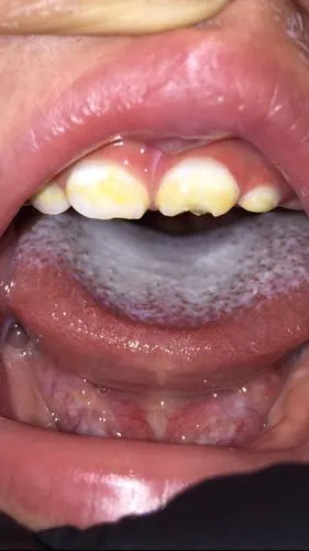 龋齿1岁宝宝牙齿这样了,怎么办,严重吗?