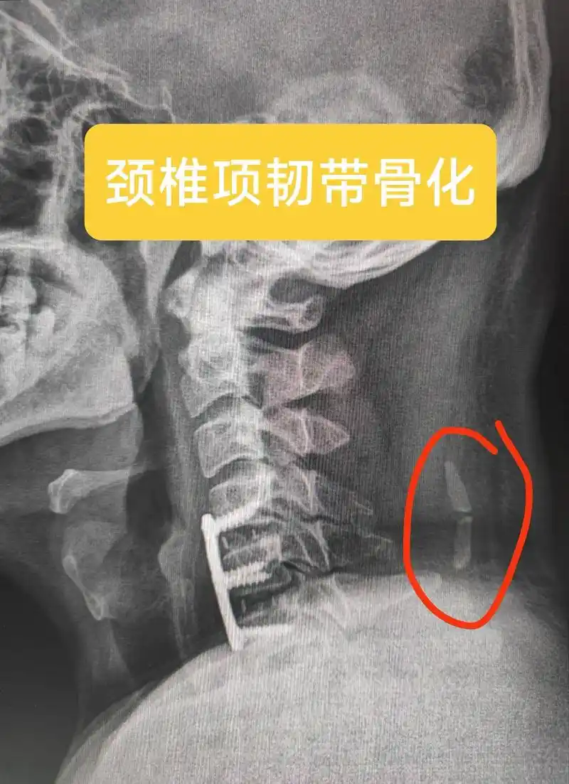 了解一下项韧带钙化