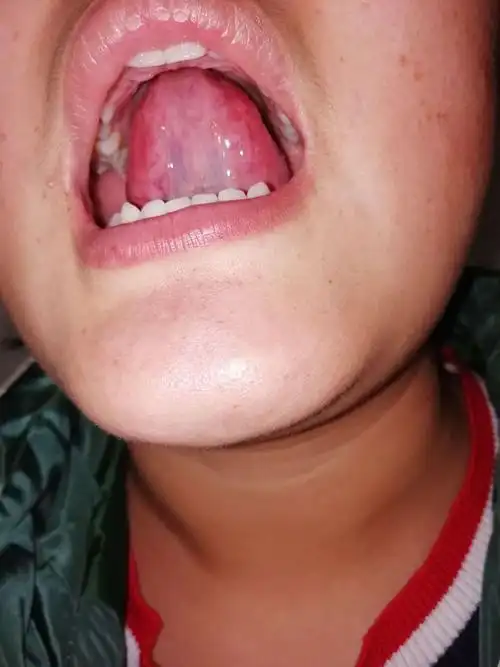 舌下络脉稍有瘀滞